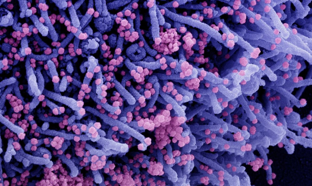 Micrografia eletrônica de varredura colorida de uma célula infectada com uma cepa variante de partículas do vírus SARS-CoV-2 (laranja), isolada de uma amostra de paciente (Imagem: National Institute of Allergy and Infectious Diseases/ NIAID)