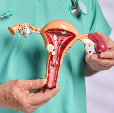 Endometriose: doença afeta até 10% das mulheres em idade fértil - Foto: Ascom SES/SE